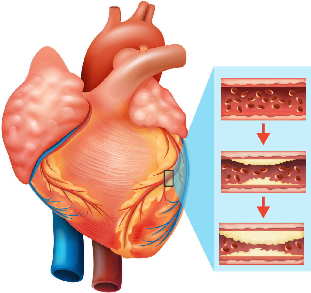 doenças do coração, O que são as principais doenças do coração?, Abreu Cardiologia