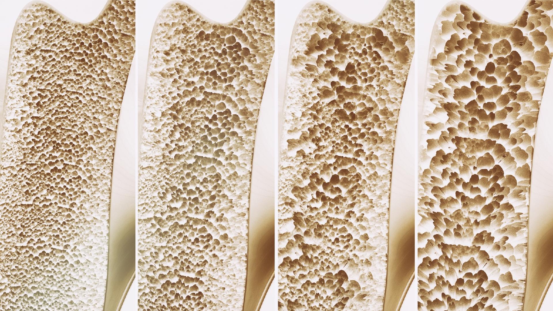 osteoporose, Osteoporose: saiba mais sobre a doença, Abreu Cardiologia